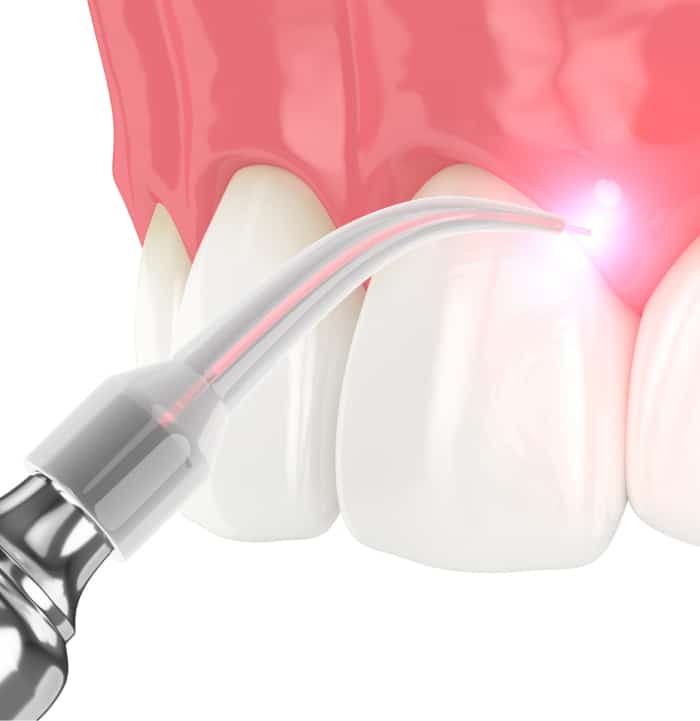 Graphic illustration of dentist using laser around gum line.